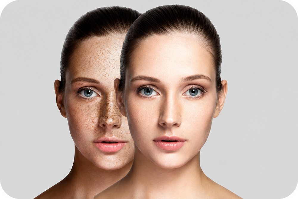keapotek.com-skin_before_after